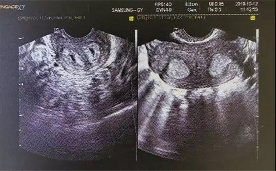 雅安恒博医院提醒:子宫有这道“墙”需及时“拆除”