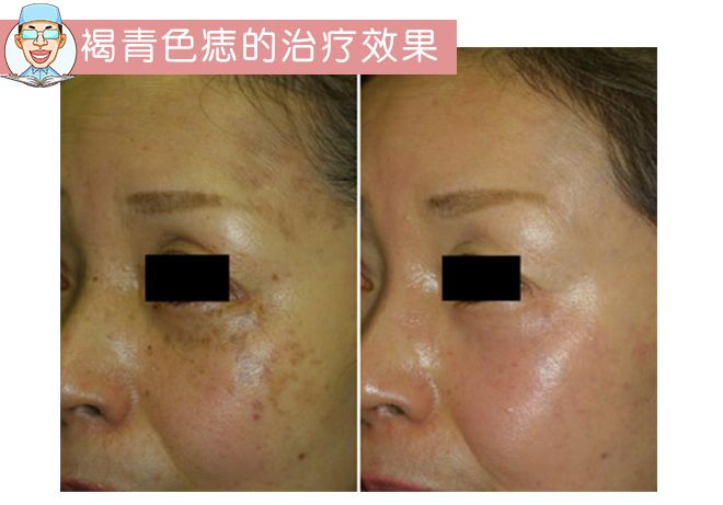 褐青色痣和斑的区别,褐青色痣斑是怎么形成的