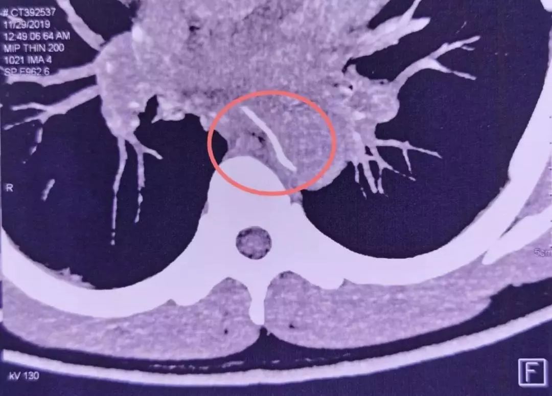 鱼刺卡住喉咙吞饭引危险,吃鱼吞了一根鱼刺开胸手术