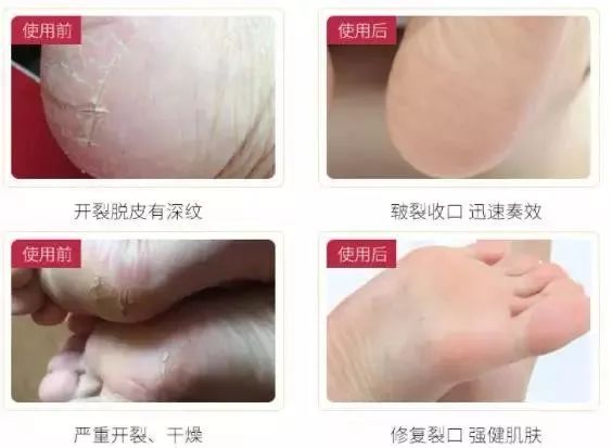呵护手足|戴手套=精油SPA？还不耽误玩手机？30分钟急救手膜足膜，死皮老茧全消失，让你从头嫩到脚