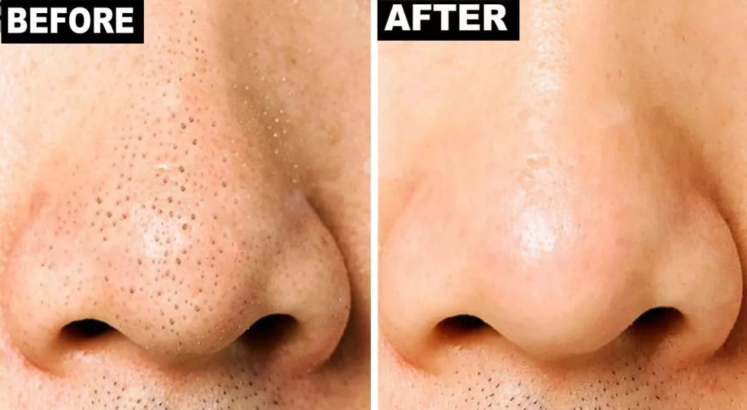 脸上搓下来很多泥,脸上搓出黑头