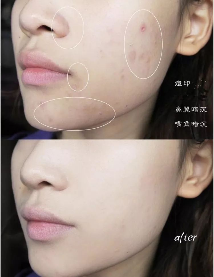 卡粉起皮怎么补救没有面霜和水乳,卡粉起皮怎么补救油皮