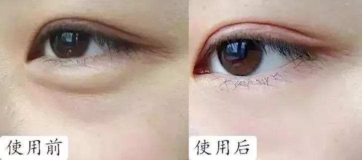 马应龙紧致型眼膜,马应龙眼膜视频