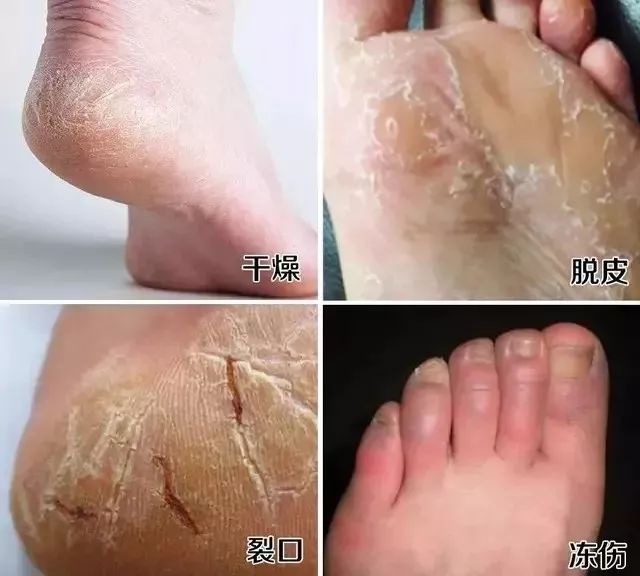 零下20度不冻脚,零下-20°不穿秋裤