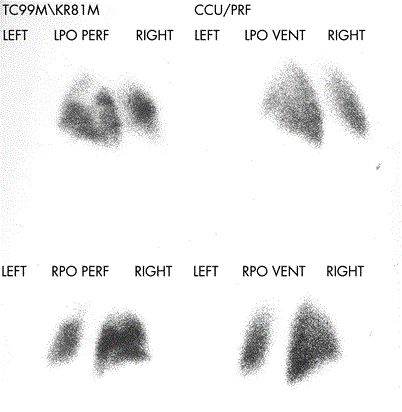 完全性左束支传导阻滞胸痛,左前分支传导阻滞胸痛