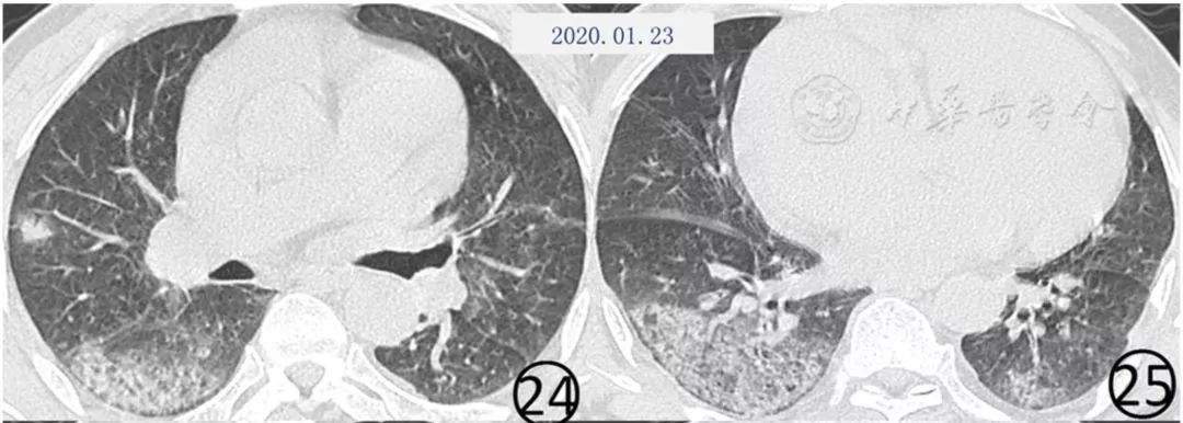 新冠肺炎影像演变过程,新冠肺炎胸部影像学特点有哪些