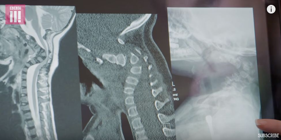 细微的骨折是一种怎样的疼痛感,骨折的疼痛有一群人要体会几十次