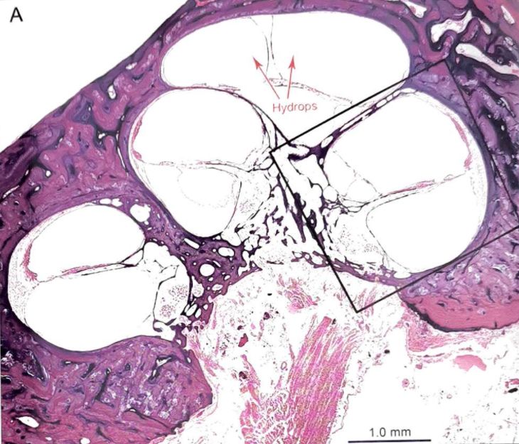 梅尼埃病深度解析,梅尼埃病病理解剖