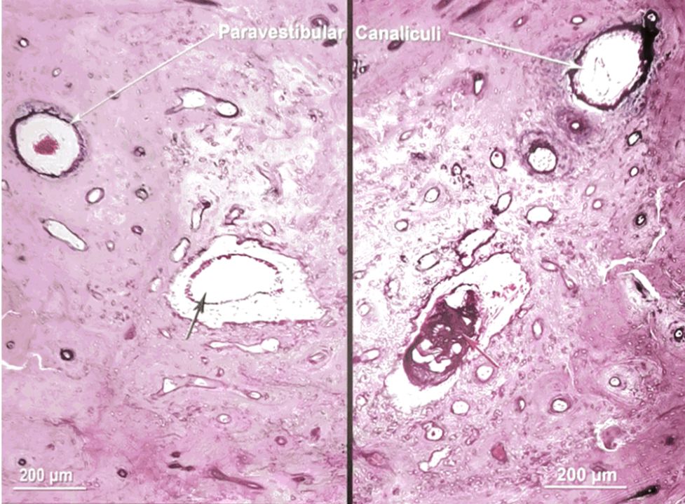 梅尼埃病深度解析,梅尼埃病病理解剖