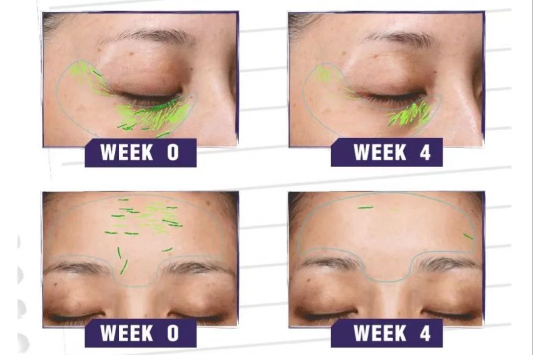 欧莱雅紫熨斗上眼皮干纹,欧莱雅眼霜紫熨斗油皮