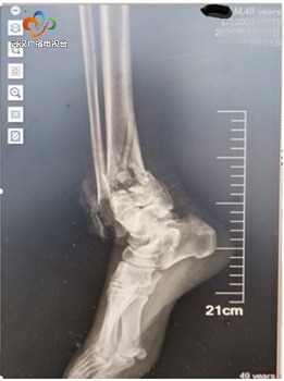 两米货架摔下脚骨碎成8块医生穿“暴汗服”拼好碎骨