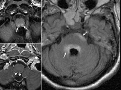 张星虎视神经脊髓炎,张星虎多发性硬化