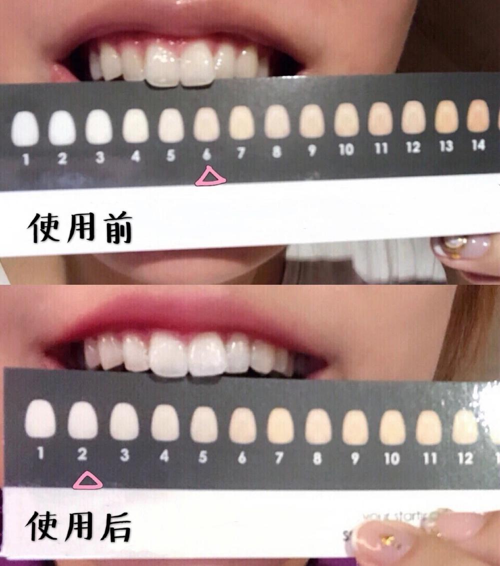 牙龈肿了出血口臭牙黄用什么牙膏,牙龈上火牙膏