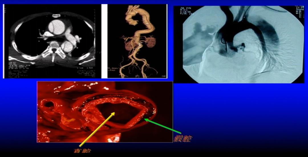 胸痛急救知识点,急性胸痛的诊断思路