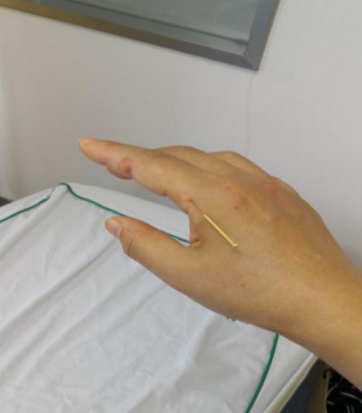 【筋伤园地】想要治疗疤痕，不妨这样试试