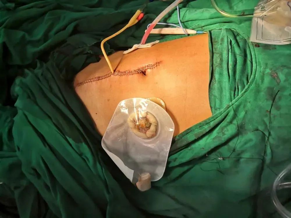 男子35厘米钢筋直穿腹部内脏！惠东医生上演生死时速