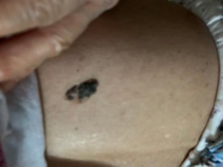 黑痣癌变的痣会很大吗,黑痣癌变一般是一个痣还是好多