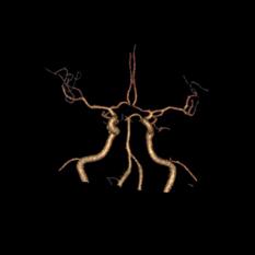 左侧大脑后动脉开窗畸形图片,脑部基底动脉开窗畸形如何治疗