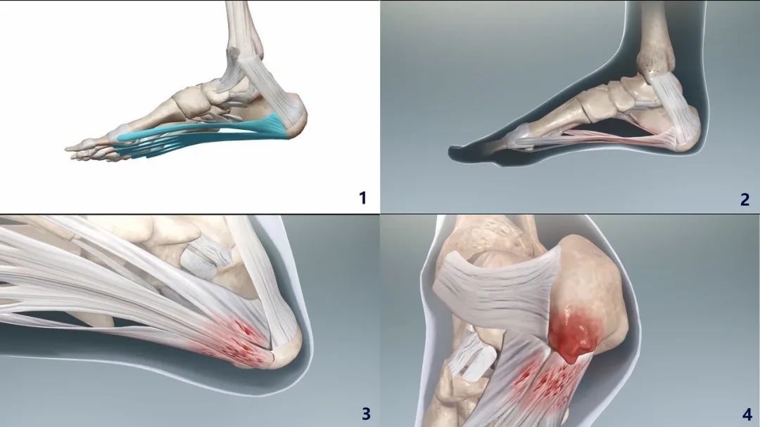 骨刺不治的后果,骨刺严重吗能看好吗