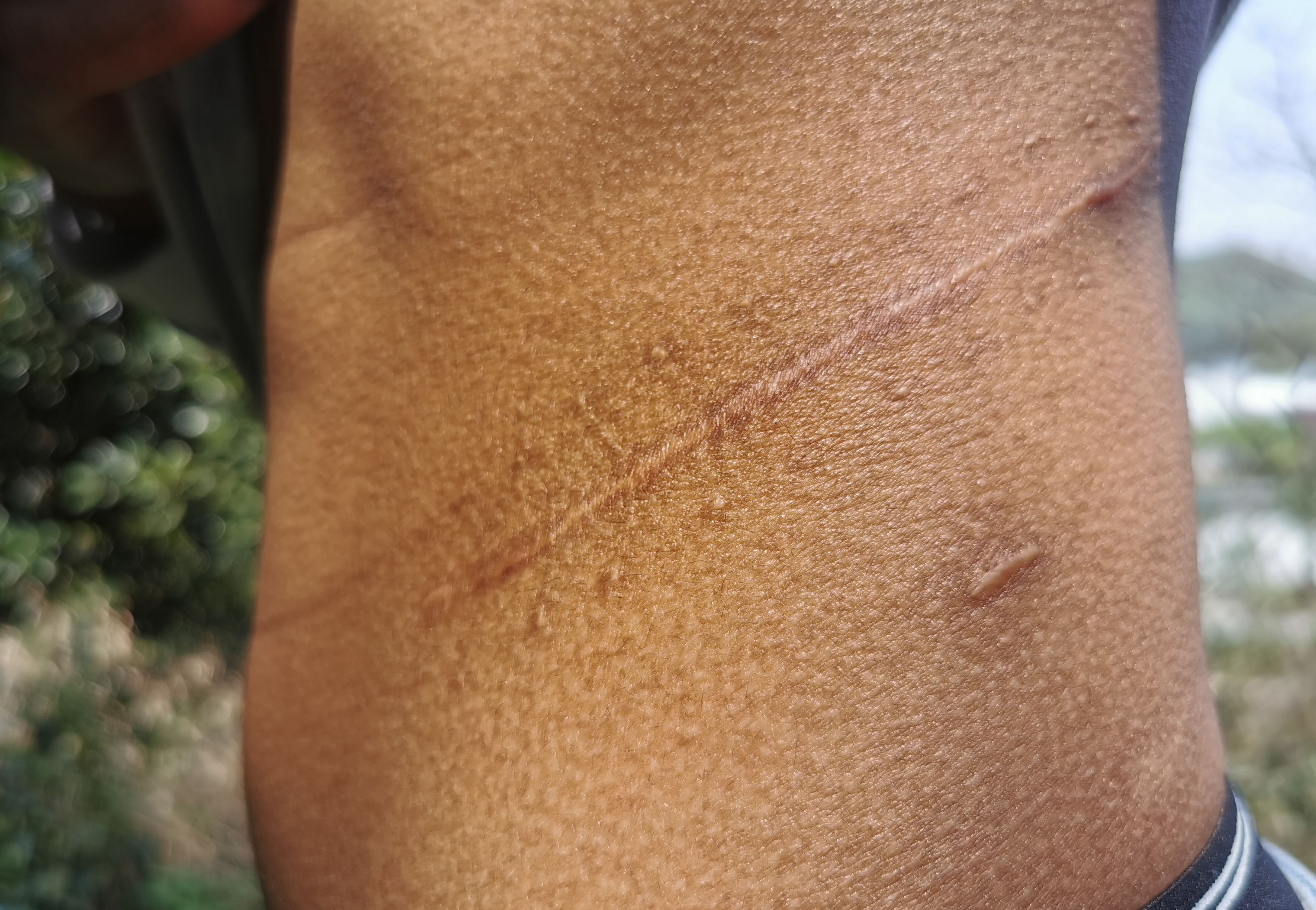 废弃厂房里的肾移植交易:买肾55万,卖肾只得4.5万