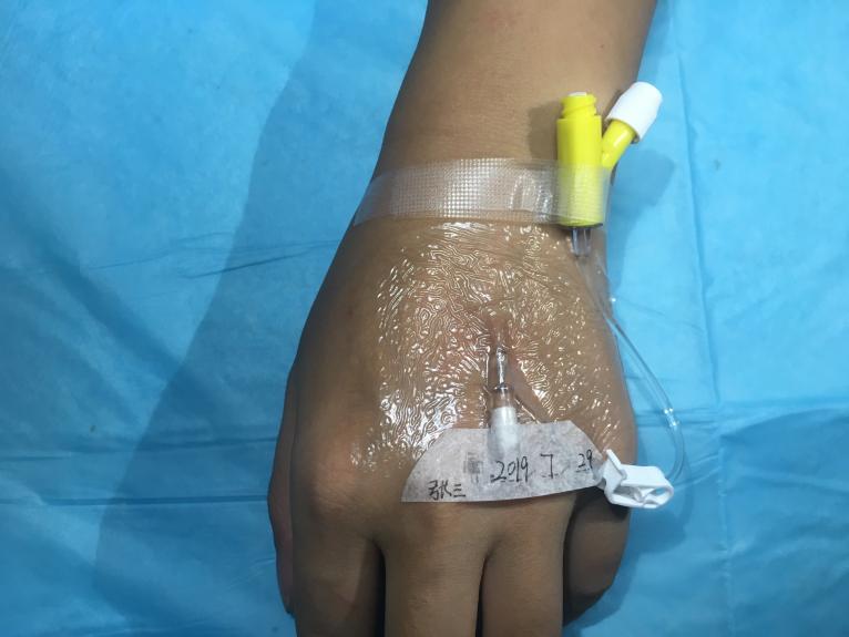 留置针堵管案例分析ppt,降低烧伤患者静脉留置针堵管率