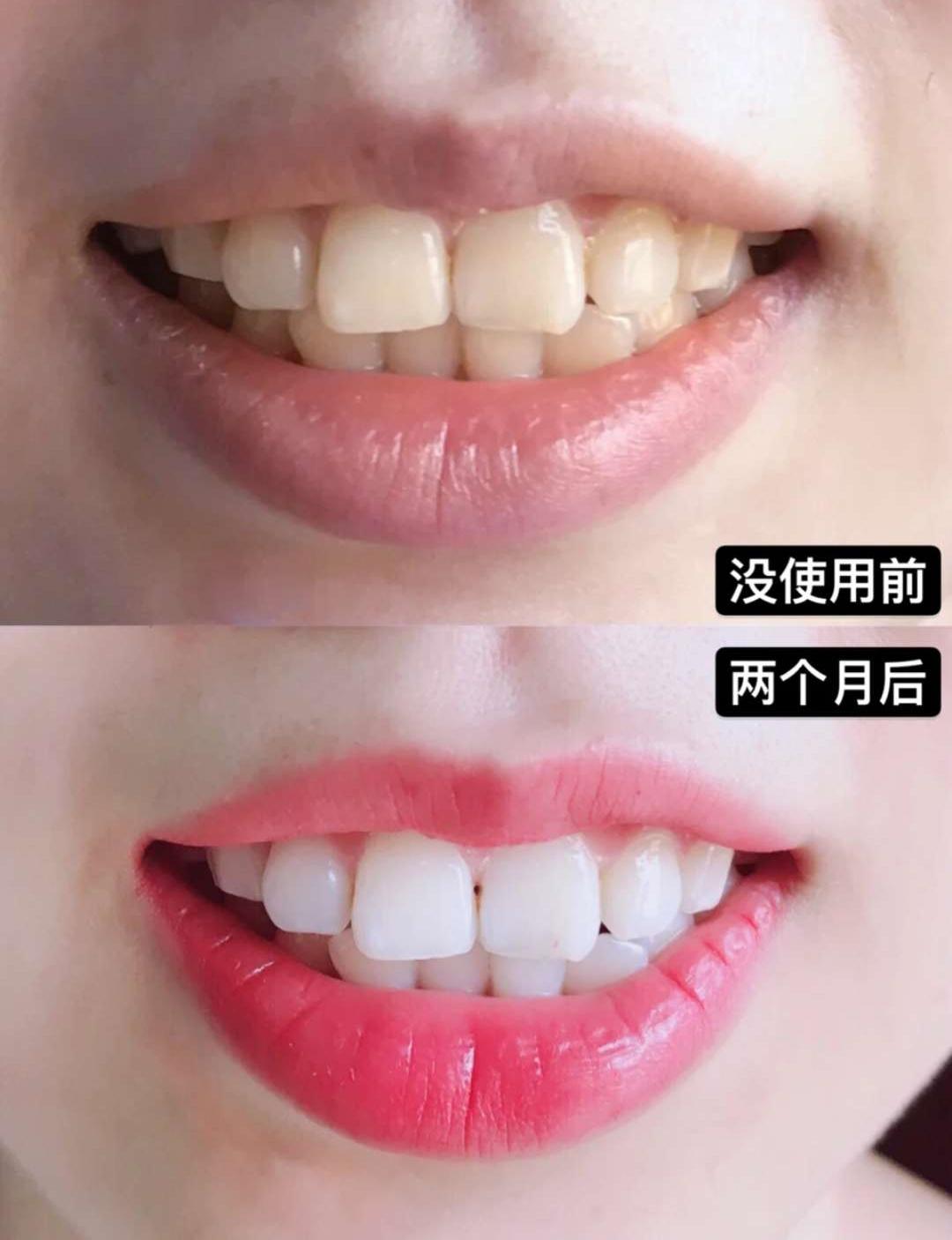 牙龈肿了出血口臭牙黄用什么牙膏,牙龈上火牙膏