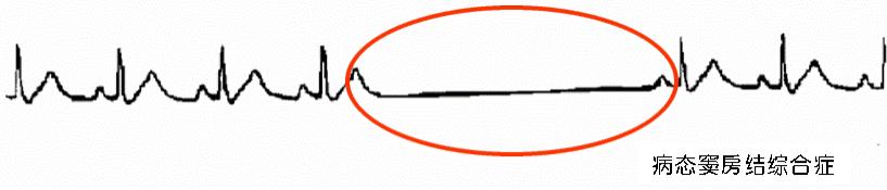 心动过缓不要慌,心脏起搏器来帮忙