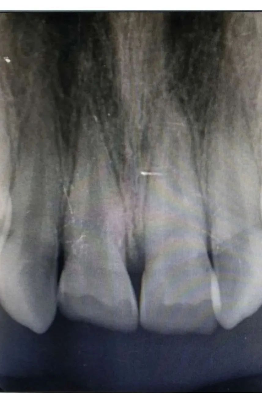 一岁小孩磕断两颗门牙有啥说法吗,两小孩无意碰撞牙齿磕断
