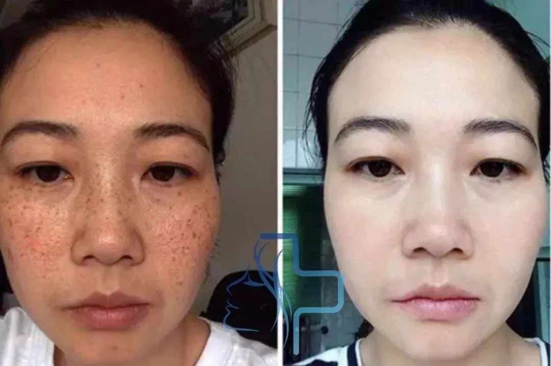 喝胶原蛋白要坚持多久才能有效果,紧急提醒经常喝这个的人要注意了