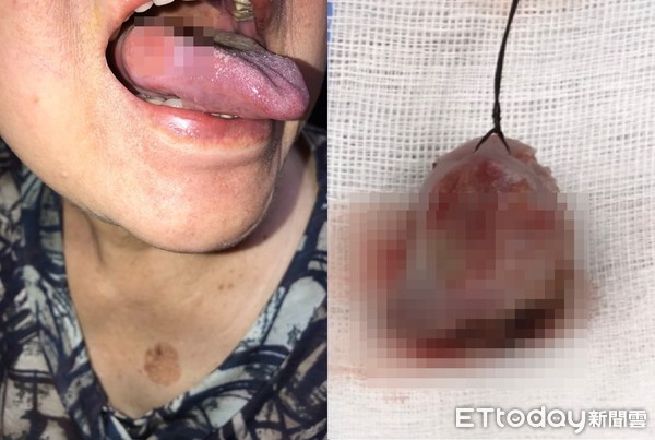 舌头发霉！她硬撑2个月竟烂出10元深窟　医叹：第二期了