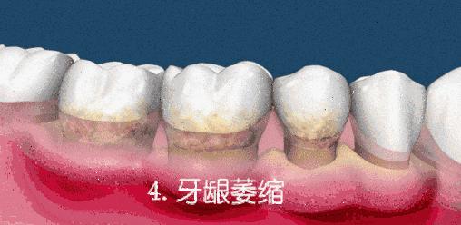 烟黄牙齿用什么牙膏牙齿能变白,黄牙烟渍牙有救了