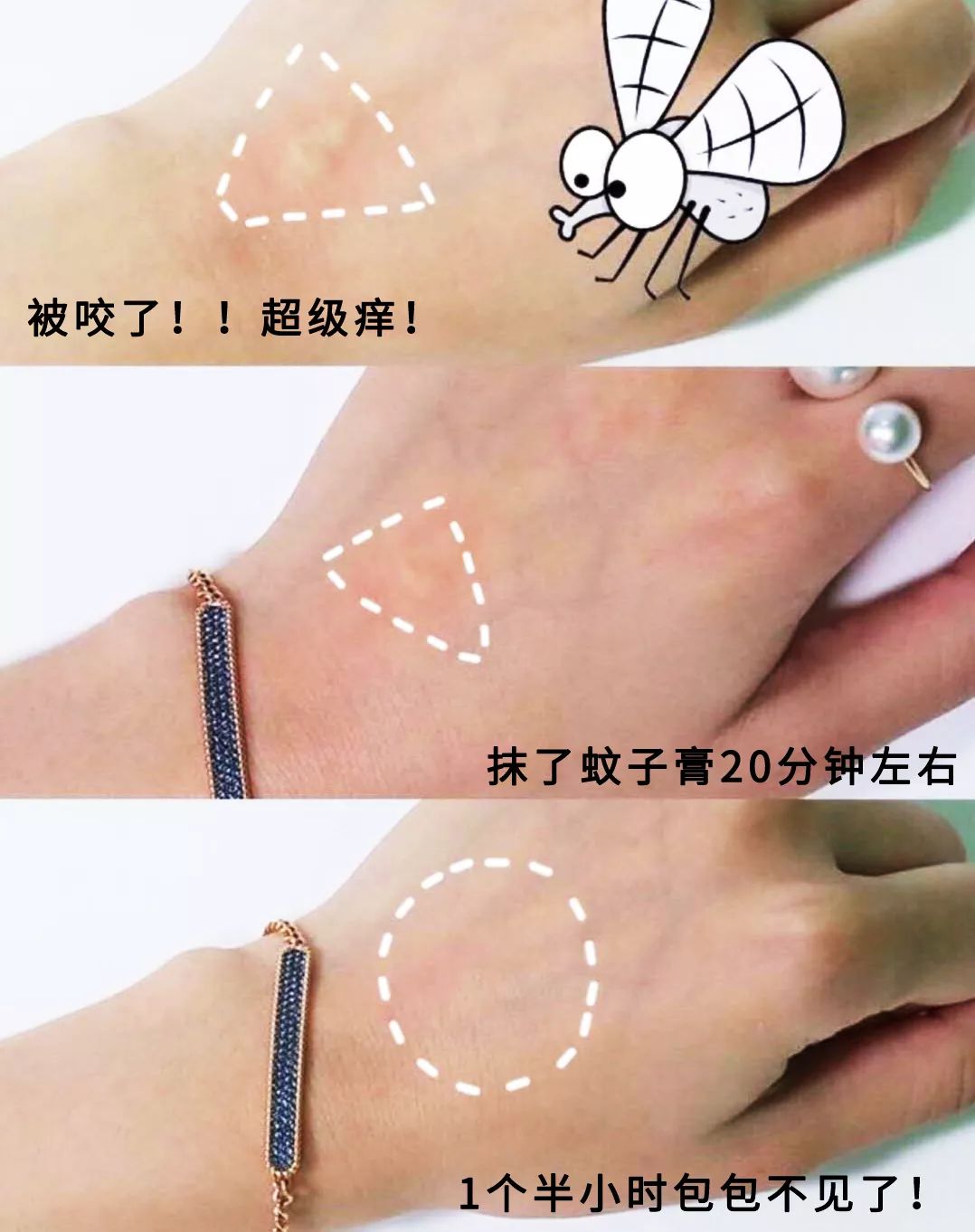 教你2分钟快速止痒,一小瓶止痒的药膏