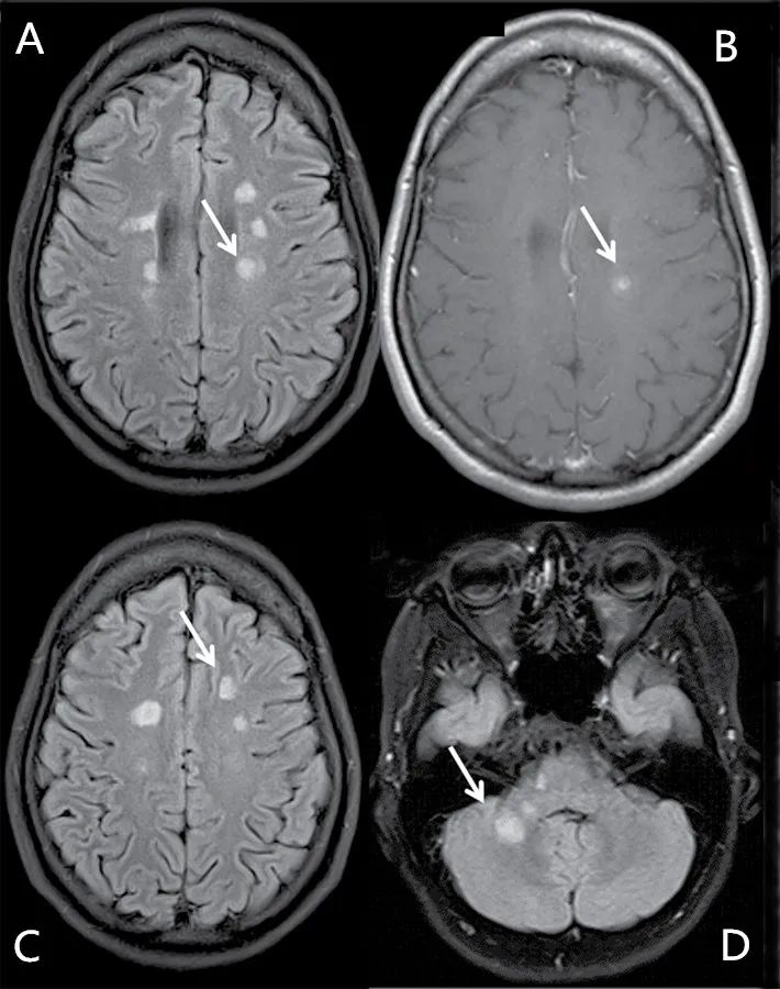 哪些东西能帮助多发性硬化恢复,多发性硬化治疗原则和方法
