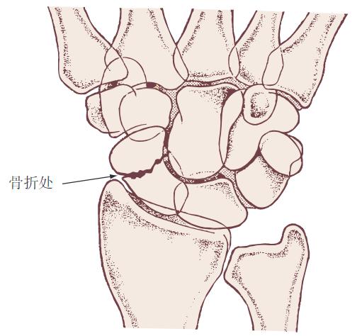 腕部损伤与康复,腕部损伤正确处理方法