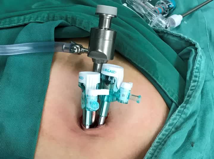 单孔腹腔镜手术王鹏,王鹏做手术