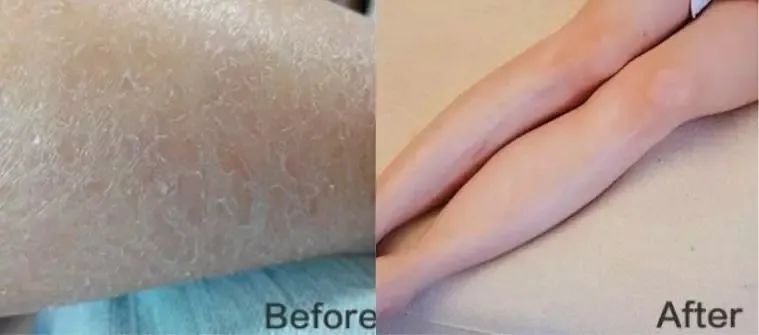 啤酒消痘痘,喝啤酒会消除痘痘吗