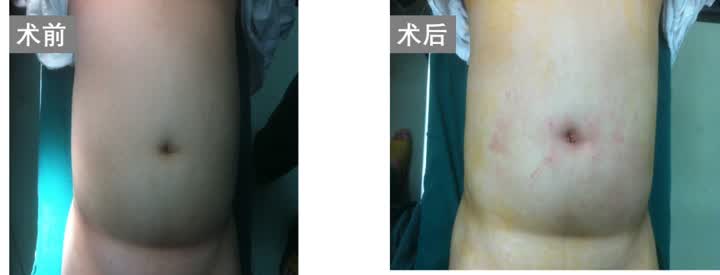 单孔腹腔镜手术南通,单孔腹腔镜手术后康复