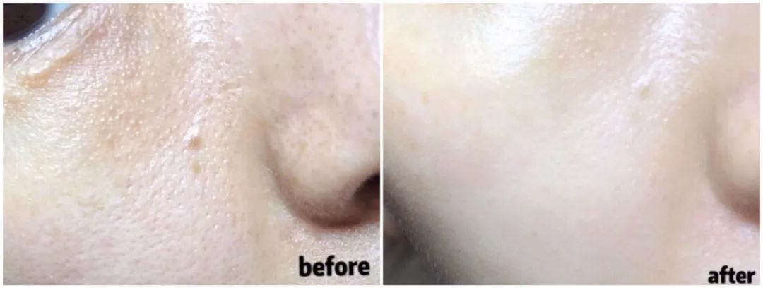 超微小气泡毛孔吸尘器使用方法,毛孔吸尘器去黑头收缩毛孔