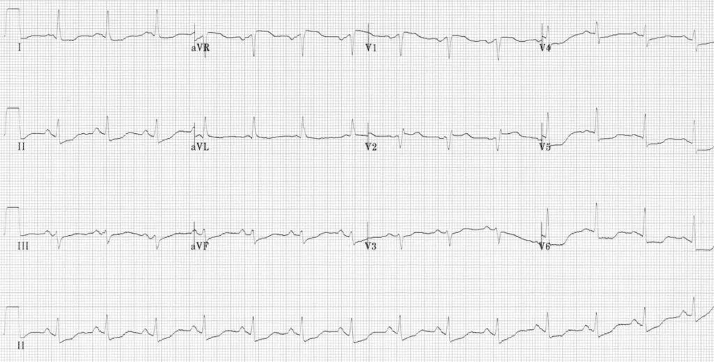心肌缺血的心电图图解,心肌缺血的典型心电图图片