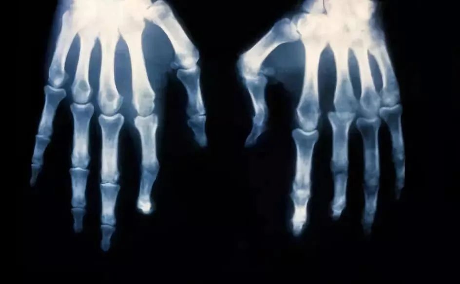 银屑病不是基因问题可以治愈吗,银屑病属不属于牛皮癣