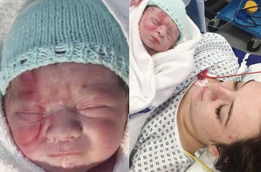 宝宝出生被产钳夹死,产钳夹出来的孩子后遗症有哪些