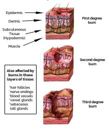 外科烧伤病人的护理教学视频,烧伤患者护理教学查房讲解视频