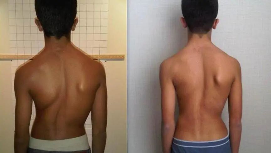 脊柱侧弯骨科治疗方法,筋骨堂正骨整脊理疗