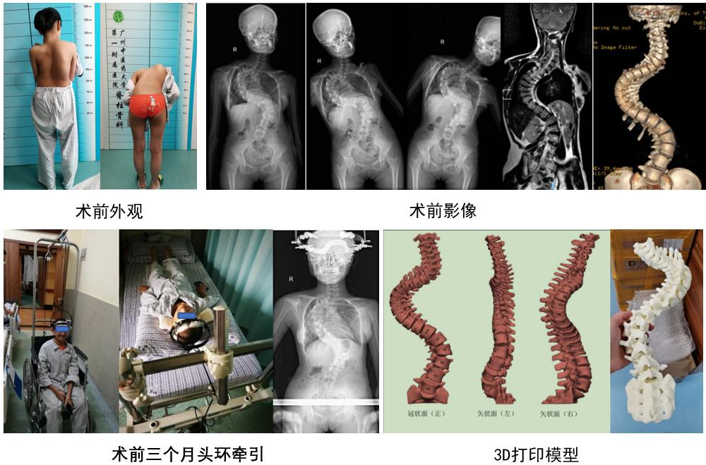 脊柱侧弯骨科治疗方法,筋骨堂正骨整脊理疗