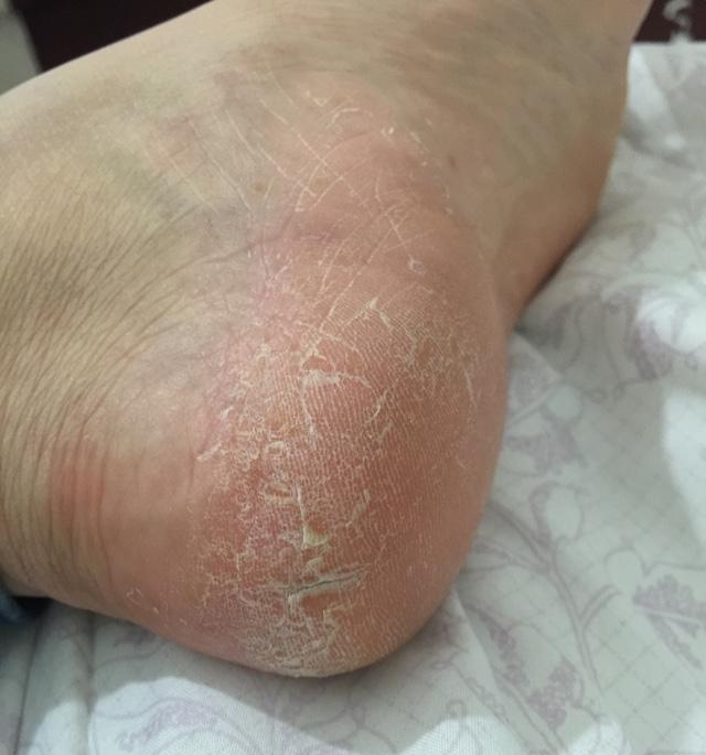 一招告别死皮老茧脚,去脚后跟老茧死皮的法子