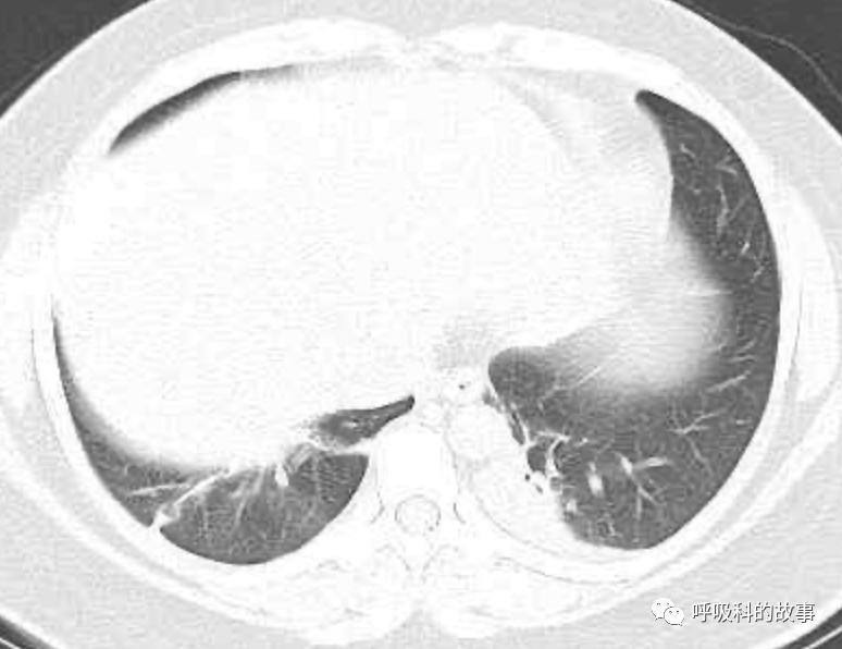 五花八门的发热之一—药物热（1）