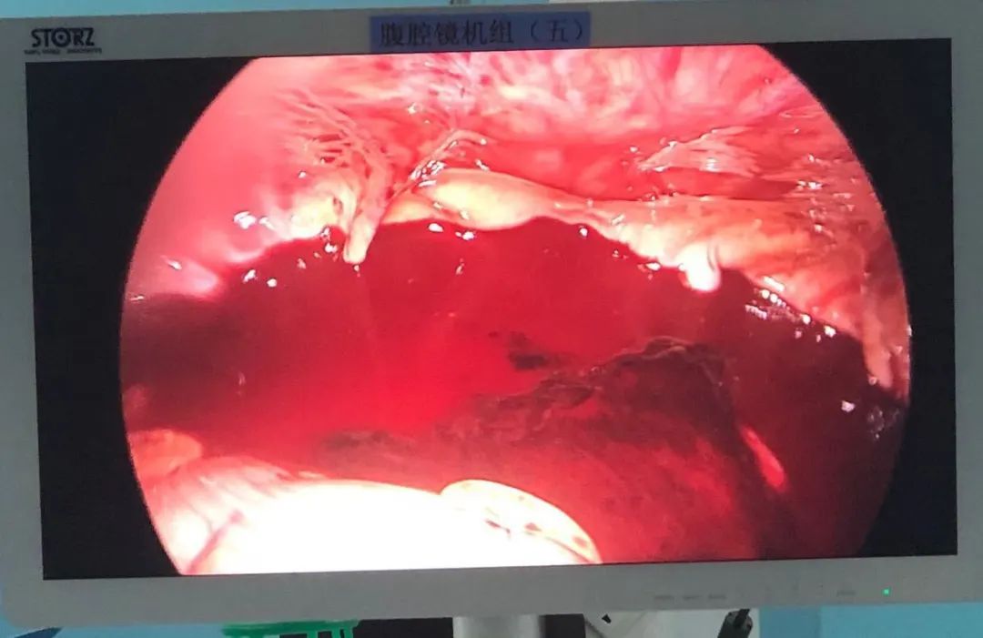 同房后“血崩”，90后姑娘差点丢了命！这个危险因素，你需要了解……