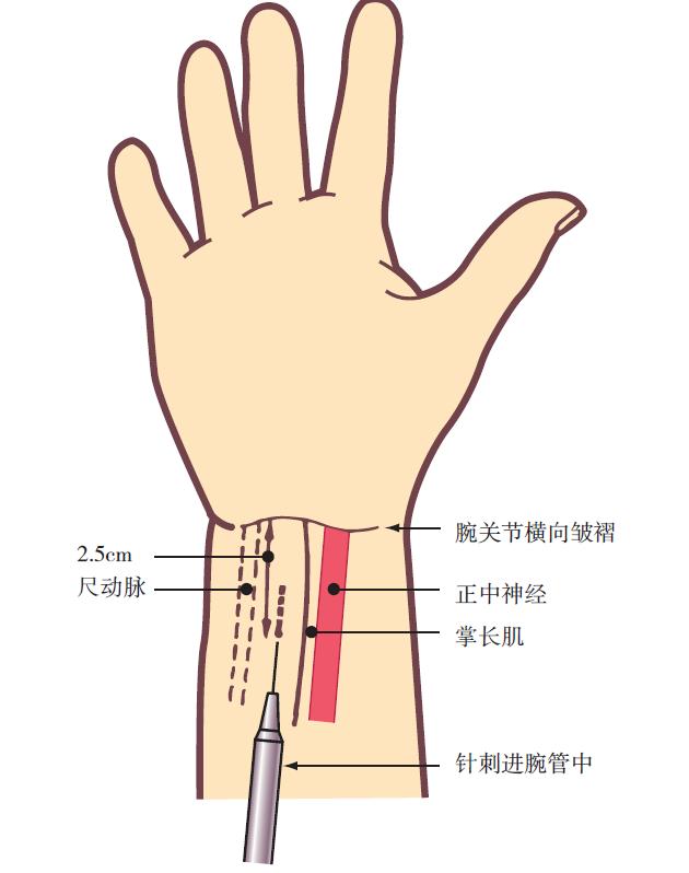 腕管综合征的诊断要点是,腕管综合征诊断标准mr
