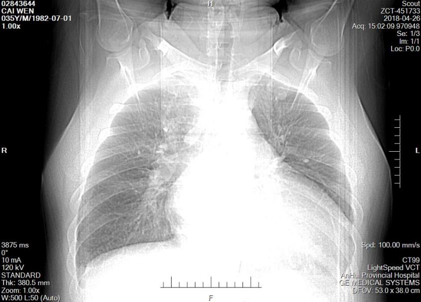专家讲解arni药治疗心衰病例,抗心衰药物arni