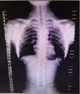 孩子弯腰驼背高低肩,孩子弯腰驼背体态难看